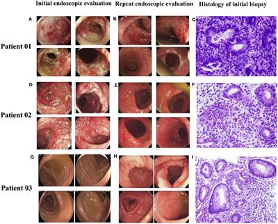 Immune checkpoint inhibitor-induced colitis with endoscopic evaluation in Chinese cancer patients: a single-centre retrospective study